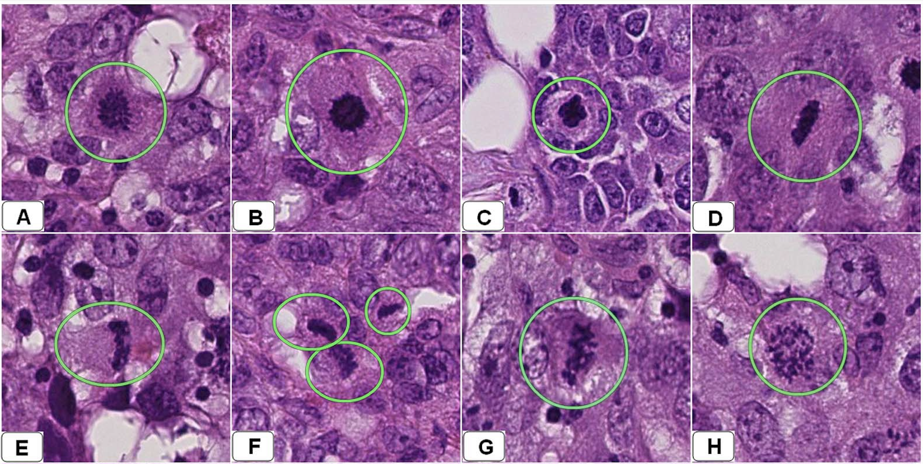 Cancer Detection